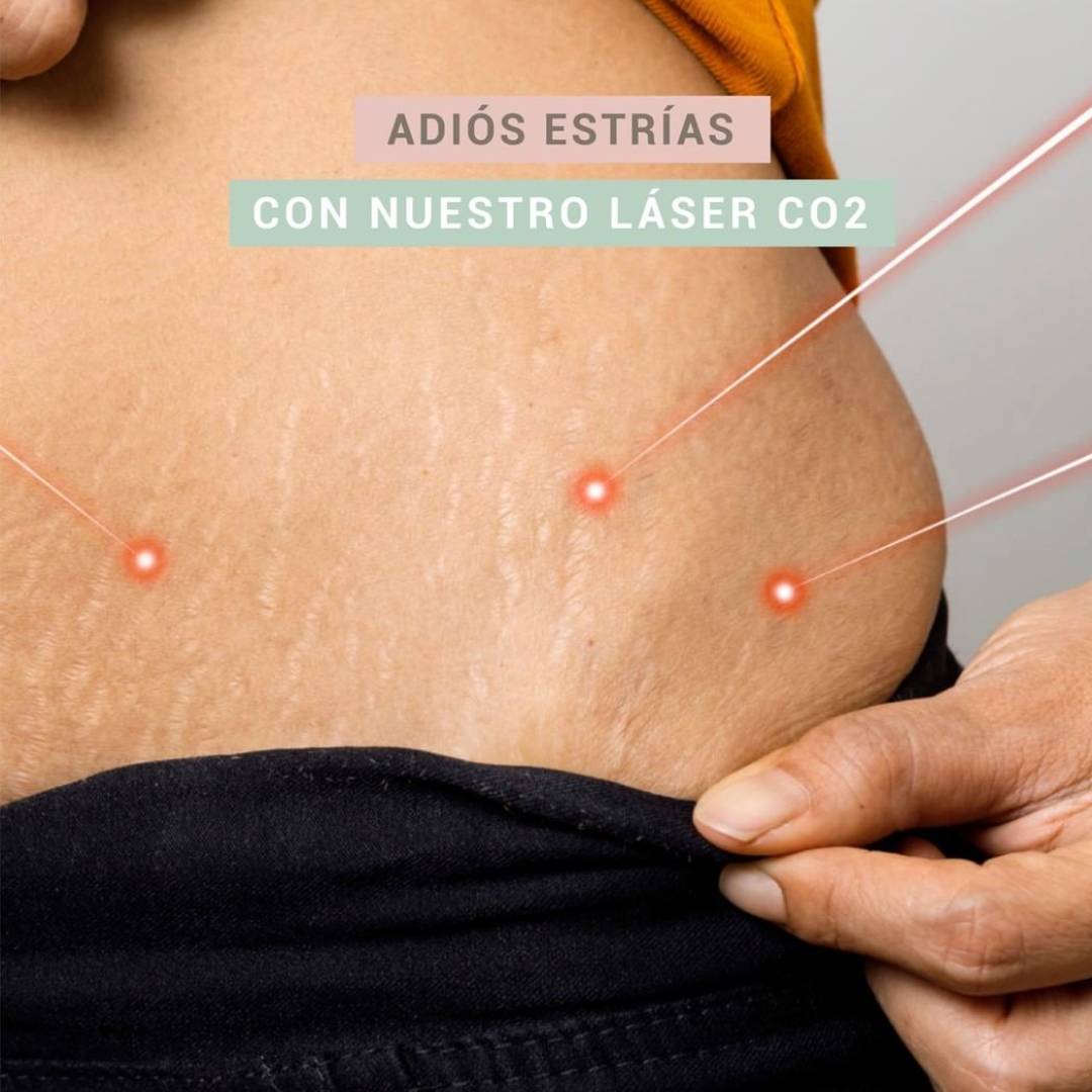 Adiós Estrias medicina estetica