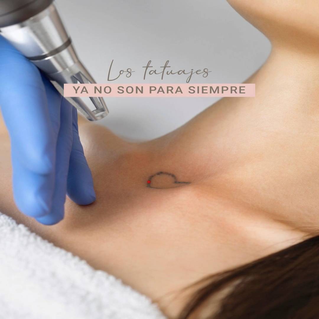 Eliminación de Tatuajes medicina estetica