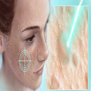 laser-acne-scars-309x309